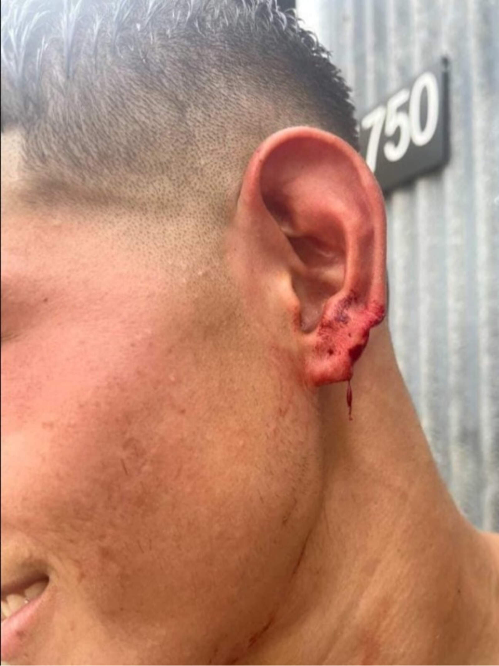 Así quedó la oreja del jugador agredido