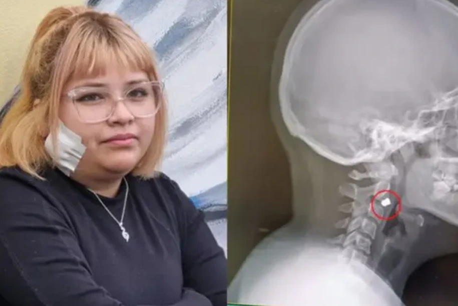 Una mujer recibió un balín directamente en su rostro, quedando el proyectil alojado en su propia mandíbula